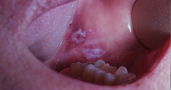 Niegojące się zmiany w jamie ustnej