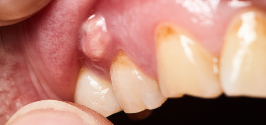 Ropień w jamie ustnej - czym jest i jak z nim postępować 