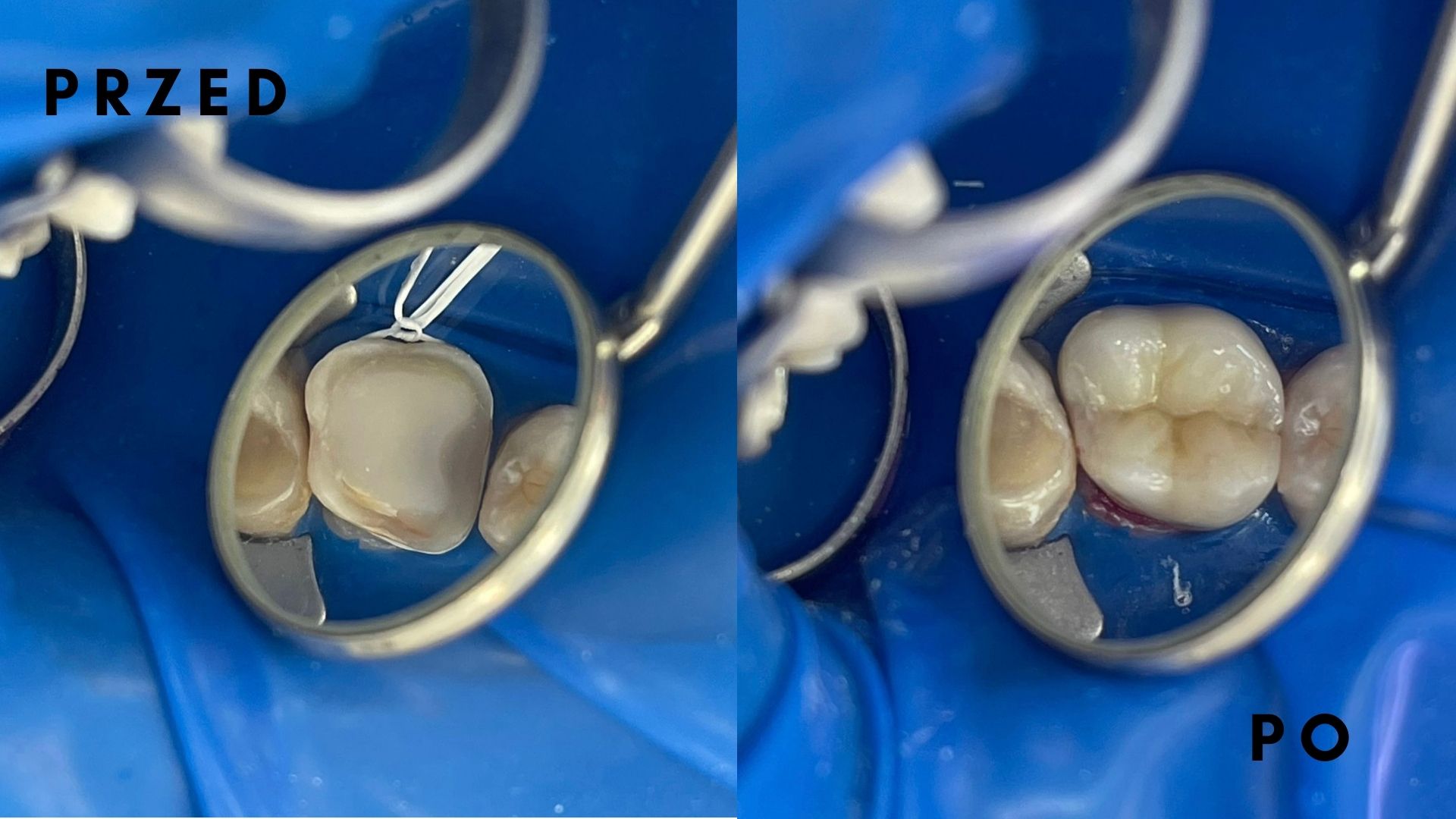 Protezy zębowe szkieletowa