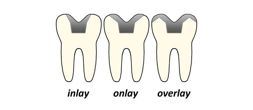 Odbudowa zęba pracą protetyczną typu inlay, onlay, overlay